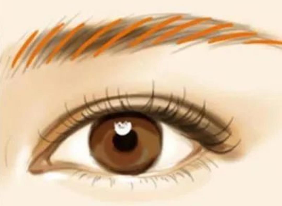 A remoção de microblading a laser (remoção de tatuagem de sobrancelha) deixará cicatrizes?